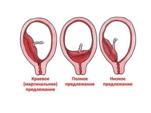 Краевое предлежание плаценты