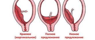 Краевое предлежание плаценты