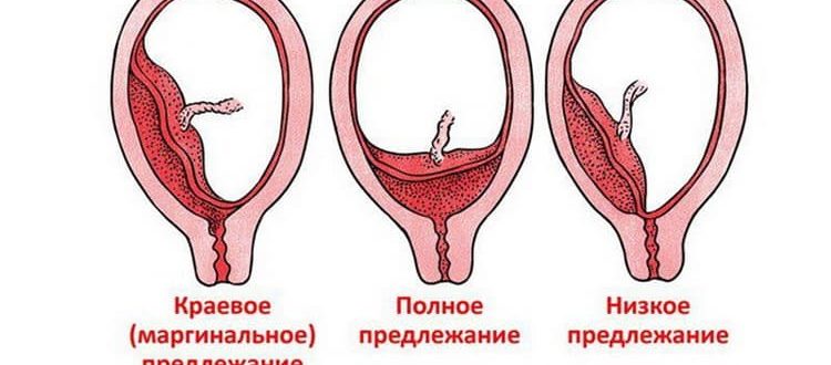 Стенка хориона. Краевое прикрепление плаценты. Типы предлежания плаценты.