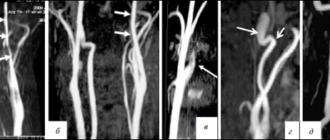 Диссекция ПА