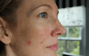 Возможна ли сильная сыпь на лице при приеме еутирокса?