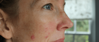 Возможна ли сильная сыпь на лице при приеме еутирокса?