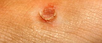 Мозоль на груди