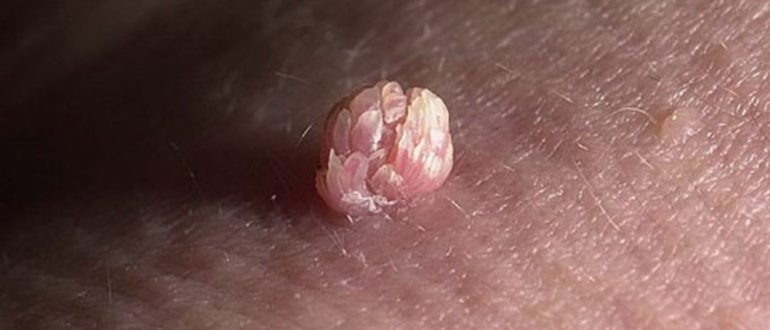 Вирус папилломы человека 16, 18