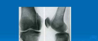 Краевой перелом надколенника, краевой перелом латерального мыщелка бедренной кости