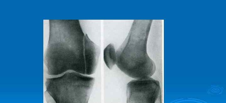 Краевой перелом надколенника, краевой перелом латерального мыщелка бедренной кости