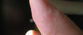 Волдырь на пальце