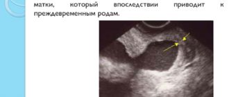 Воронкообразное расширение