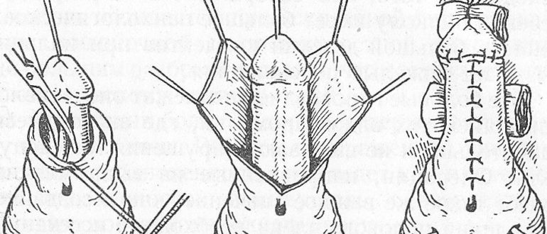 Можно ли сузить крайнюю плоть