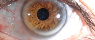 Волдырики на радужке и красные глаза