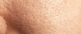 Волосы вокруг соска, расширенные поры