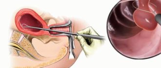 Вакуумная аспирация. Гиперплазия эндометрия