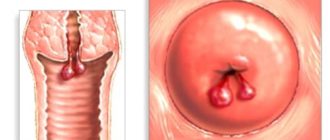 Может Полип цервикального канала сам отвалится при беременности