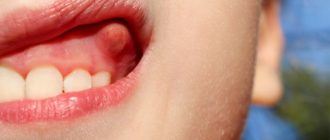 Красная линия на десне