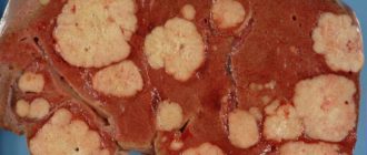 Метастазы в печень?