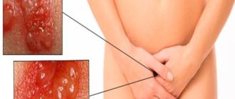 Воспаление влагалища и язвочки на половых губах после ПА