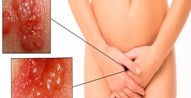 Воспаление влагалища и язвочки на половых губах после ПА