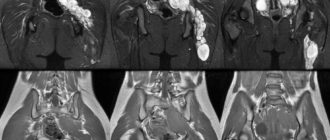 МРТ малого таза