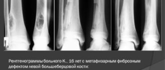 Метафизарная дисплазия млевой берцовой кости