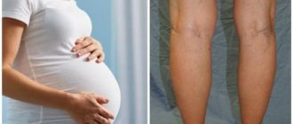 Вены после родов