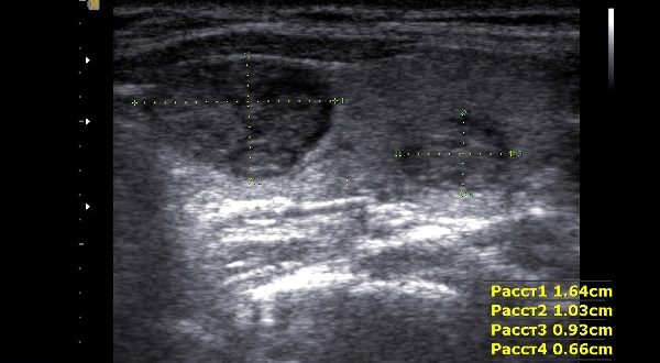 Узловой зоб расшифровка по узи