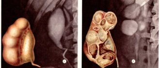Двусторонний уретерогидронефроз плода