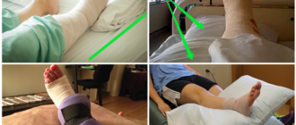 Можно ли приступать на ногу в гипсе через неделю?