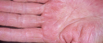 Дисгидротическая экзема ладоней на протяжении 2 месяцев при беременности 1 триместр