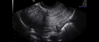 Узи после кс