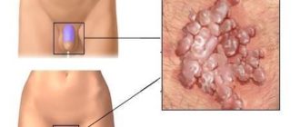 Чешутся половые губы и побаливает клитор