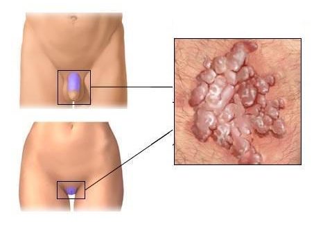 Чешутся половые губы и побаливает клитор