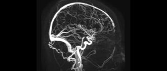 Мои головного мозга или сосудов