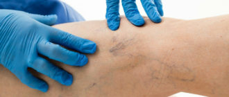 Варикозное расширение вен нижних конечностей