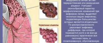 Эмфизема легких, хрип и бульканье в лежачем положении