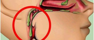 Все время сопли в носоглотке