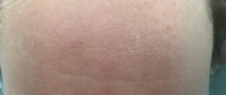 На лбу появилась красная точка