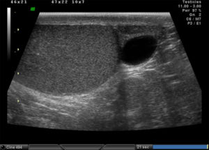 Узи органов мошонки: анэхогенные образования