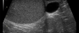Узи органов мошонки: анэхогенные образования