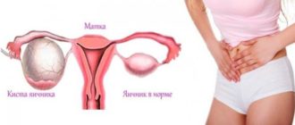 Выделения и боль в яичниках после па