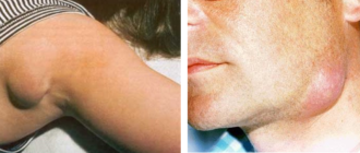 Воспалились лимфоузлы на шее, под коленом и под мышкой