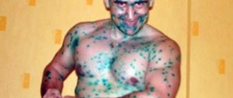 Можно ли подхватить ветрянку у прохожего мимо?