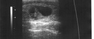 УЗИ щитовидной железы, киста правой доли