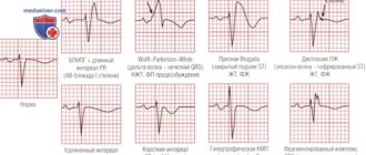 ЭКГ недостаточное восстановление в покое