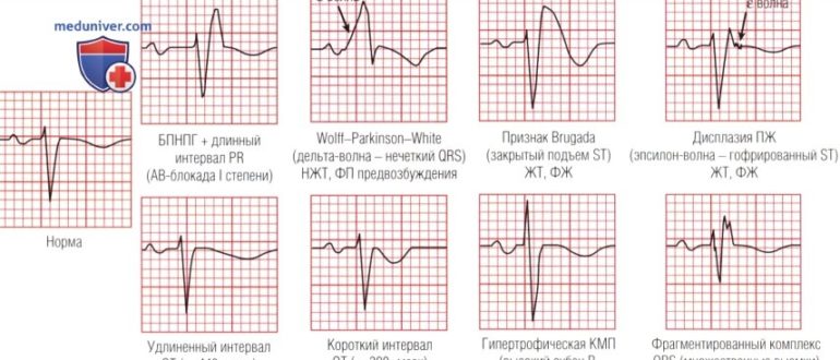 ЭКГ недостаточное восстановление в покое