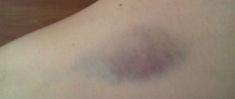 МНО низкое, большие синяки на руках