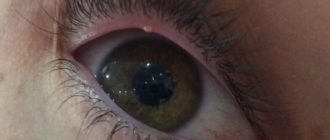 Волдырь на веке глаза