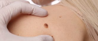 Можно ли делать электрофорез где родинка