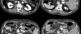 Мрт брюшной полости