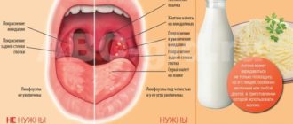 Мокрый кашель, температура, красное горло и сопли как лечить
