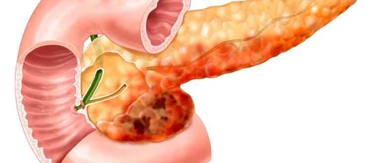 Можно ли вылечить панкреатит?